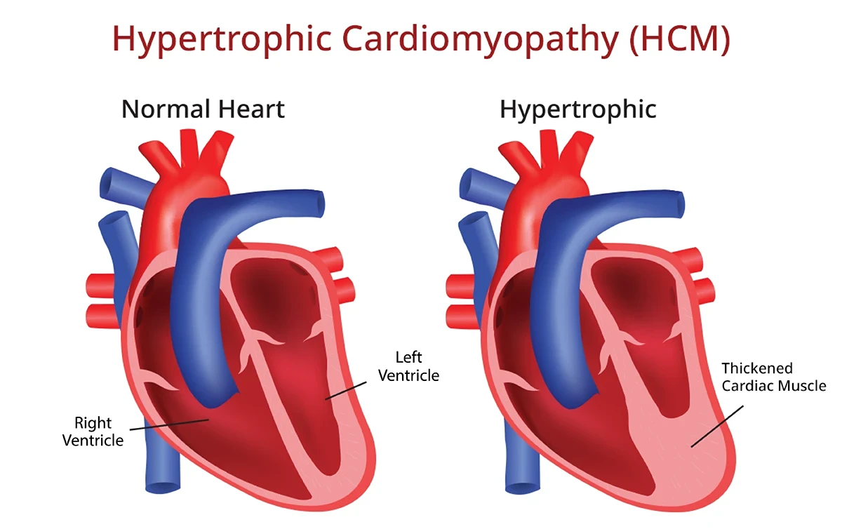 Image shows a normal, healthy heart compared to a heart impacted by hypertrophic cardiomyopathy, resulting in a thickened cardiac muscle and shortened left ventricle
