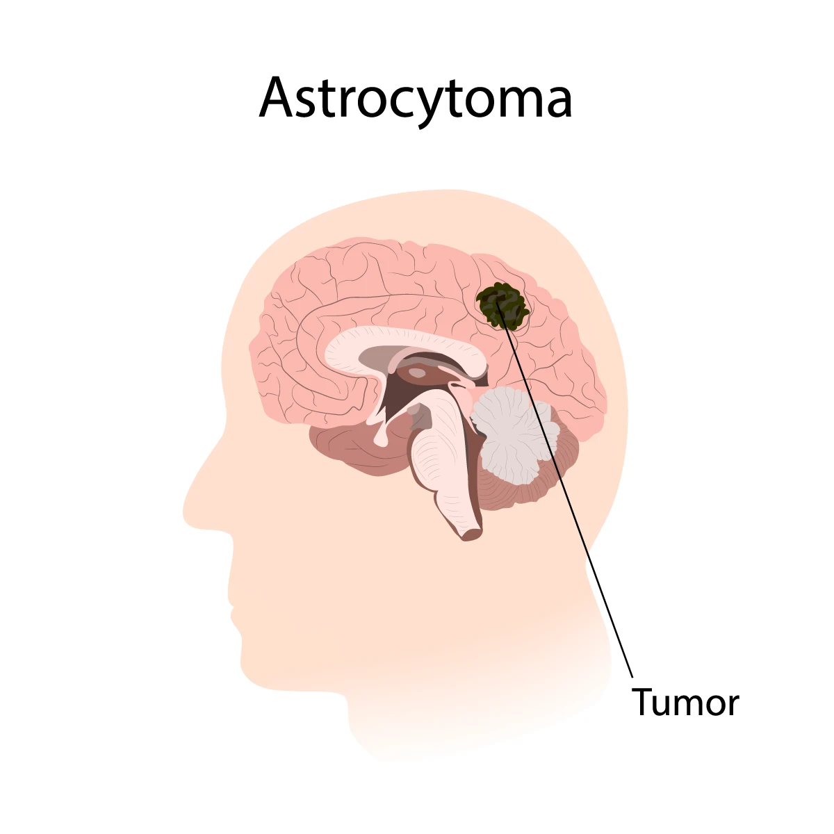 Astrocytoma