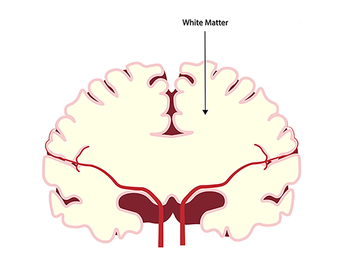 Leukodystrophy