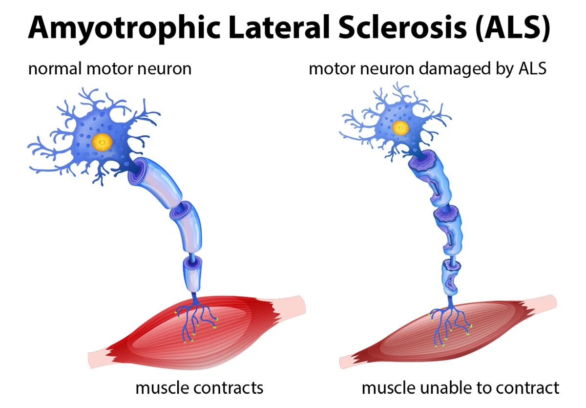 Image shows a normal motor neuron and a motor neuron damaged by ALS.