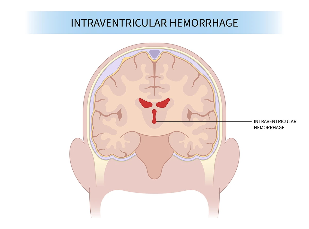 Intraventricular