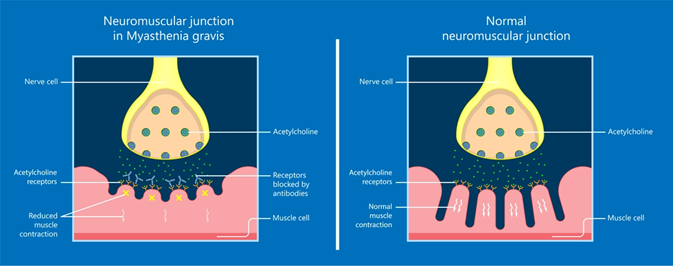 Myasthenia gravis Myasthenia gravis