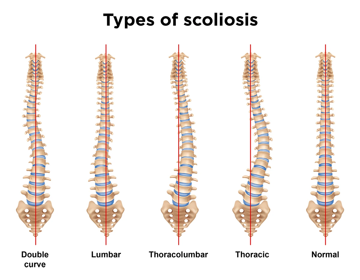 Types of scoliosis