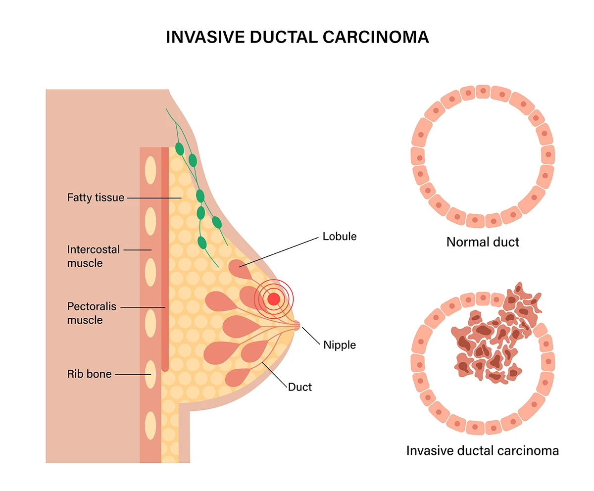 The image shows the difference between a normal milk duct in the breast tissue and one with invasive ductal carcinoma, where the cancer cells have spread outside the duct.