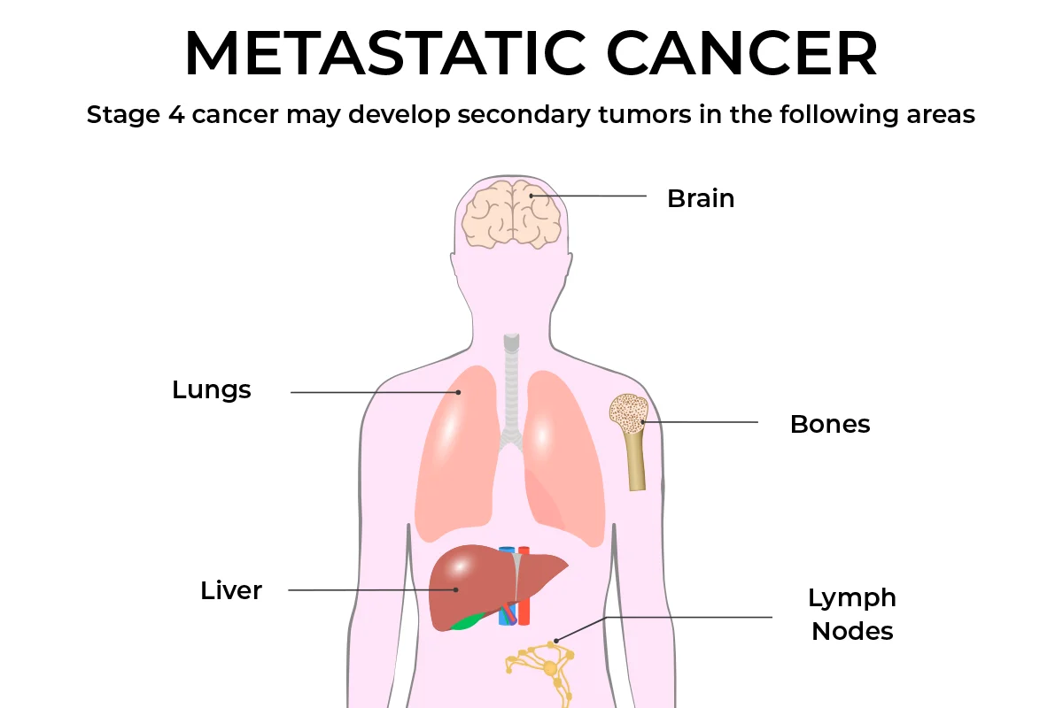 The image shows the areas metastatic breast cancer can spread, including the brain, lungs, liver, lymph nodes and bones.