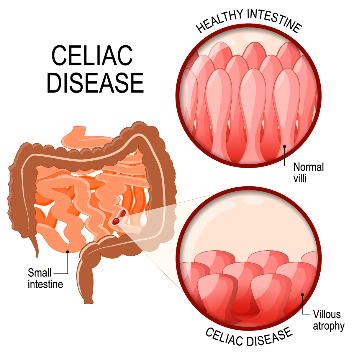 Celiac disease image