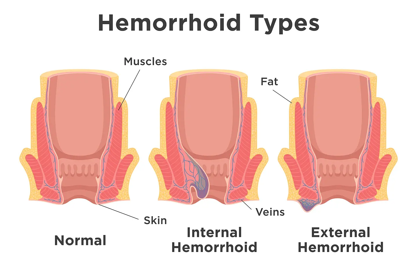 An illustration of three rectums shows what a rectal opening looks like with no hemorrhoids, with an internal hemorrhoid and with an external hemorrhoid.