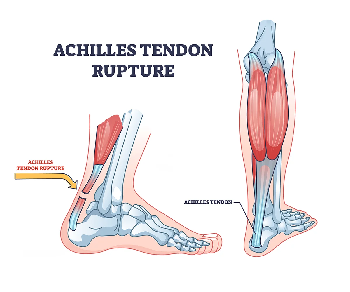 Images show a side view of a common site for rupture of the Achilles tendon and rear view of an intact Achilles tendon.