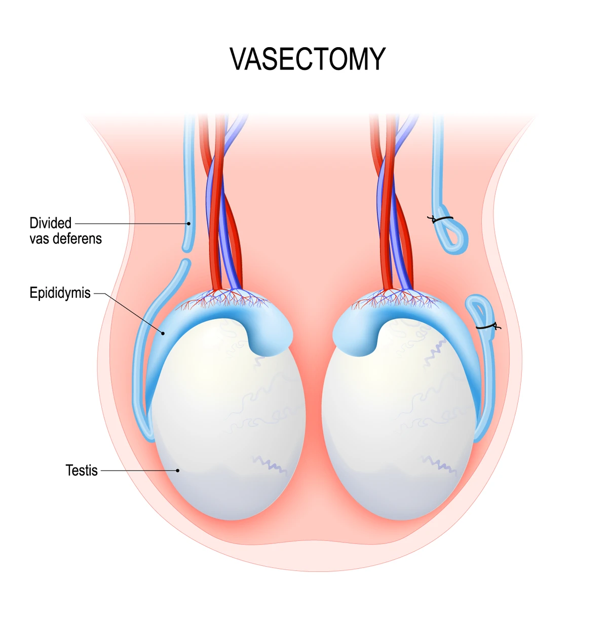 Vasectomy Vasectomy