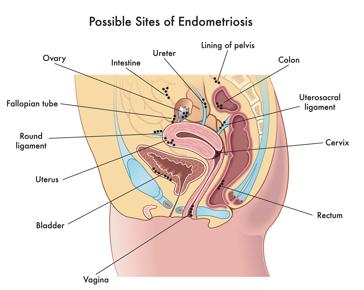 Image shows where endometriosis implants may grow, including the bladder, ureters, rectum, colon, lining of the pelvis, and the reproductive organs and structures that support them.