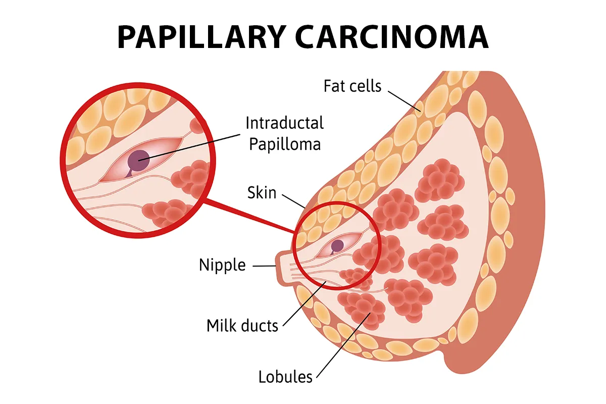 The image shows a papillary carcinoma tumor lodged in the milk duct of the breast.