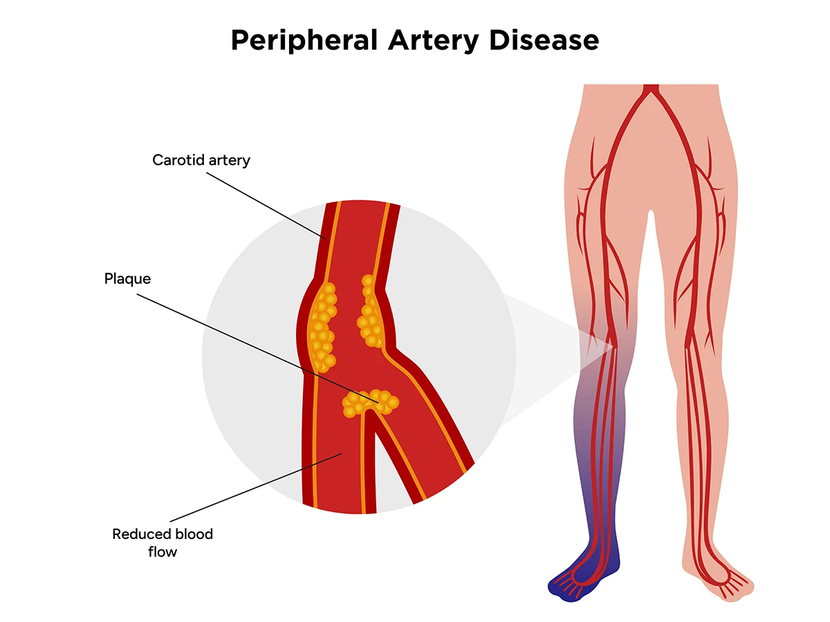 Illustration explaining peripheral artery disease, featuring plaque buildup inside an artery causing reduced blood flow, with the lower leg highlighted to indicate poor circulation.